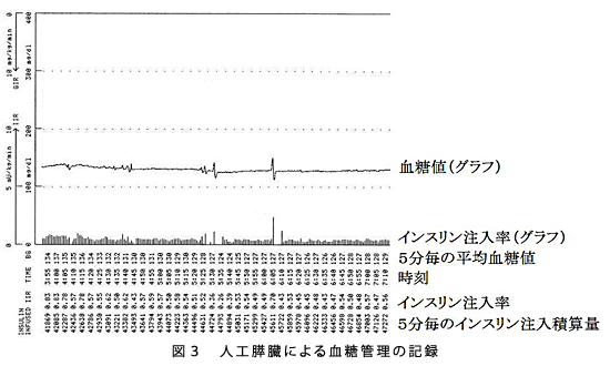 人工膵臓による血糖管理の記録